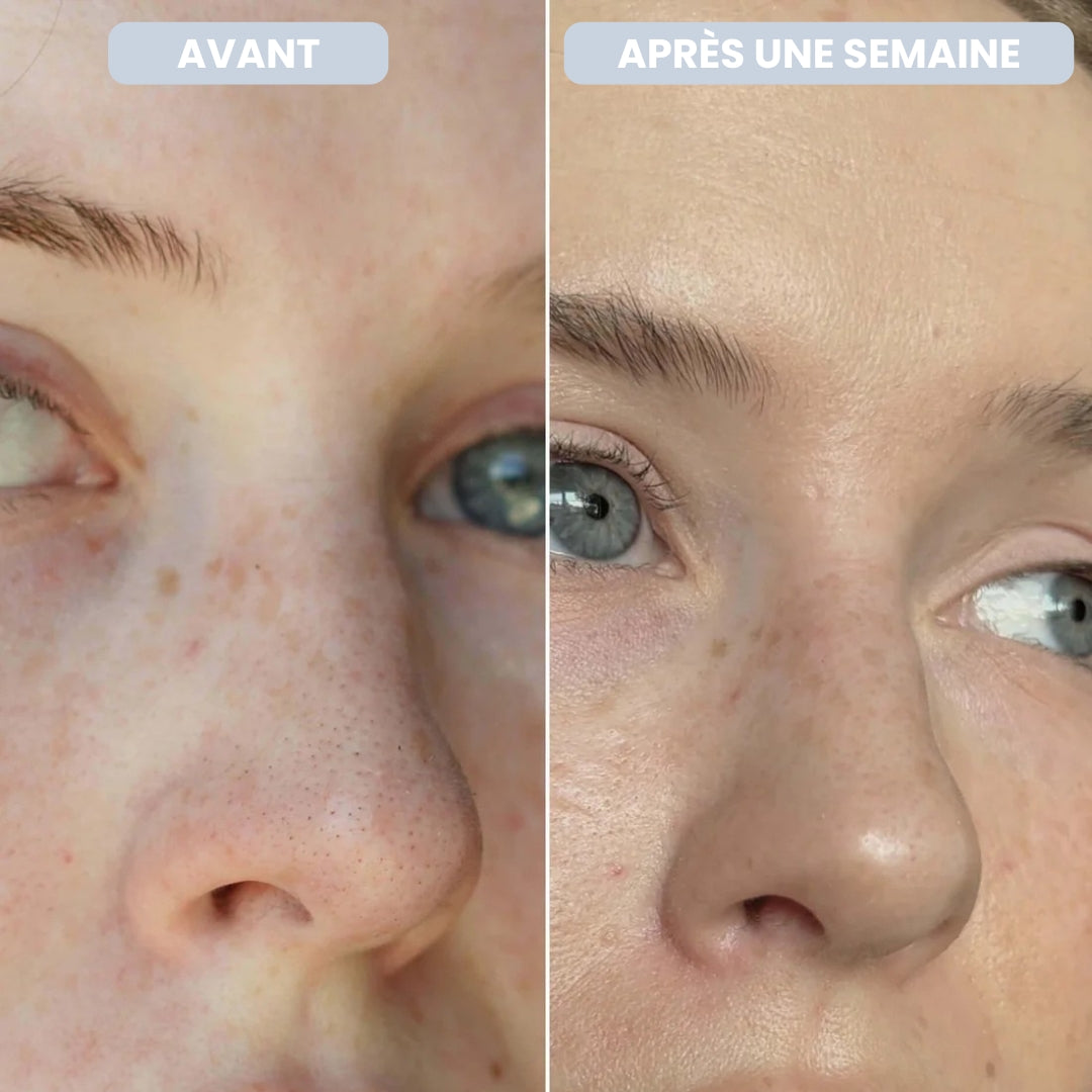 PATCHS POUR LE NEZ